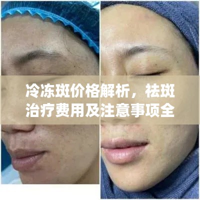 冷冻斑价格解析,祛斑治疗费用及注意事项全攻略
